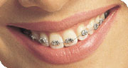 Brackets, Ormco